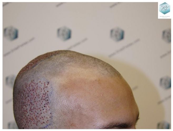 Injerto Capilar Técnica FUE 2036 Grafts (4761 Pelos) 11 trasplante de pelo valencia