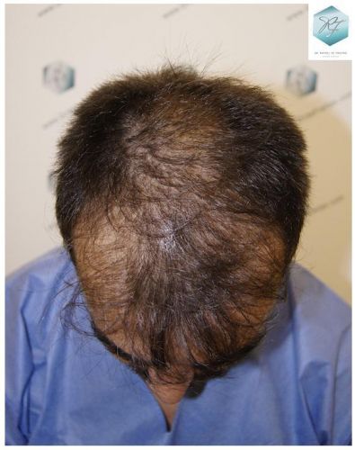 Injerto Capilar Técnica FUE 6230 Grafts (14226 Pelos) 1 trasplante de pelo valencia