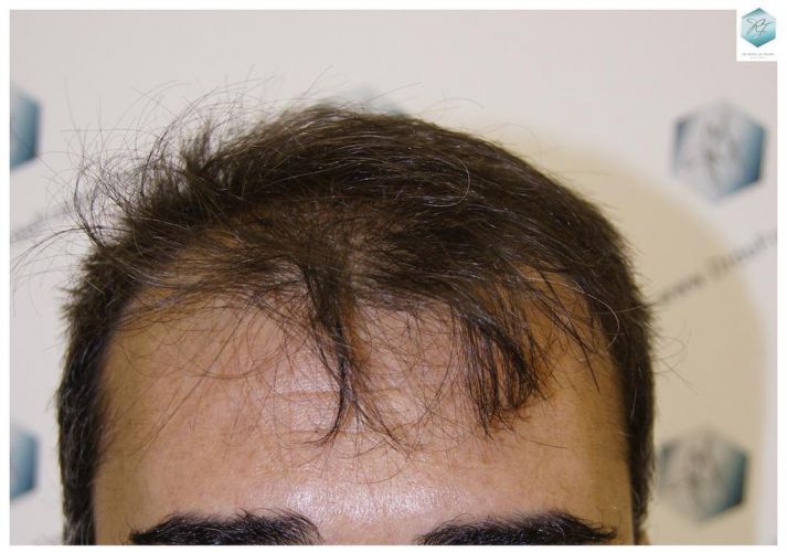 ANTES DEL TRASPLANTE CAPILAR trasplante de pelo valencia