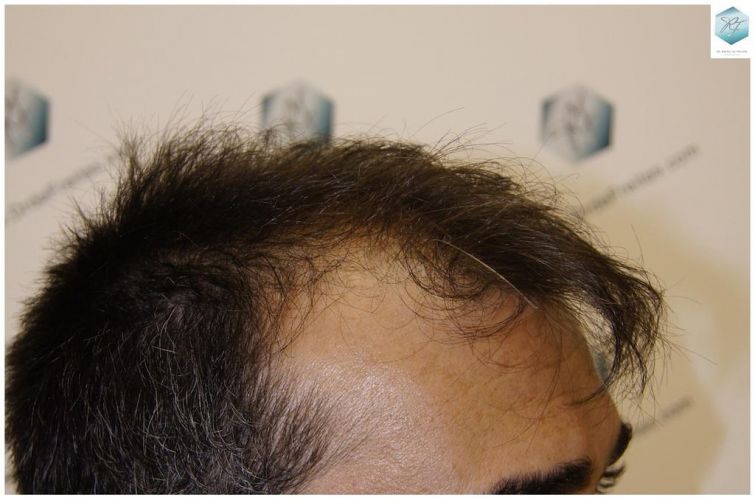 Injerto Capilar Técnica FUE 6230 Grafts (14226 Pelos) 2 trasplante de pelo valencia