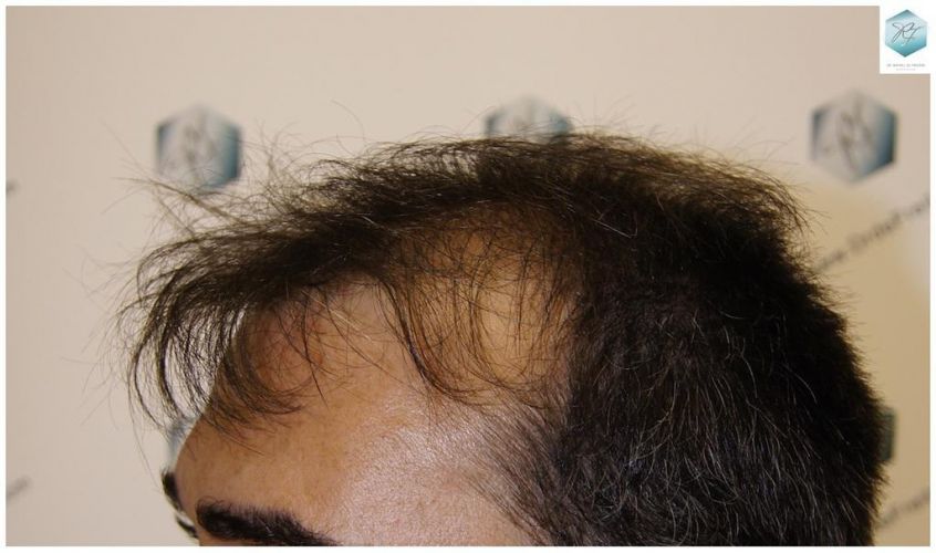 Injerto Capilar Técnica FUE 6230 Grafts (14226 Pelos) 3 trasplante de pelo valencia