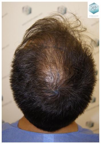 Injerto Capilar Técnica FUE 6230 Grafts (14226 Pelos) 5 trasplante de pelo valencia