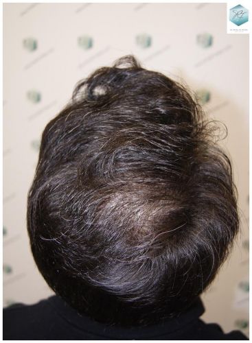 Injerto Capilar Técnica FUE 6230 Grafts (14226 Pelos) 51 trasplante de pelo valencia