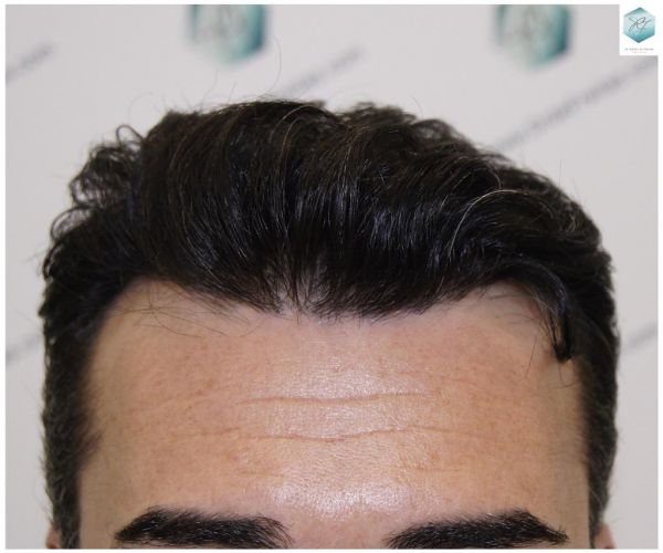 RESULTADOS A LOS 12 MESES trasplante de pelo valencia