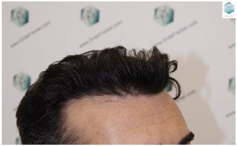 Injerto Capilar Técnica FUE 6230 Grafts (14226 Pelos) 46 trasplante de pelo valencia