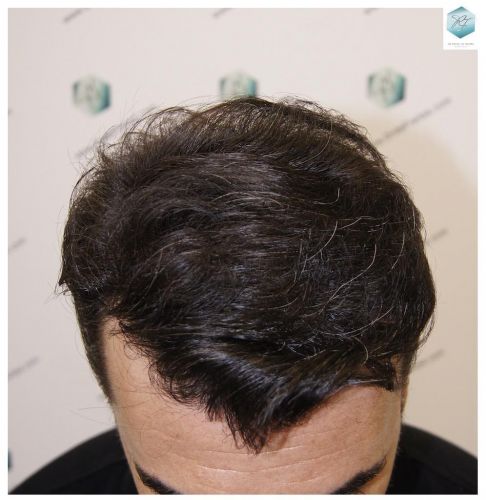 Injerto Capilar Técnica FUE 6230 Grafts (14226 Pelos) 45 trasplante de pelo valencia