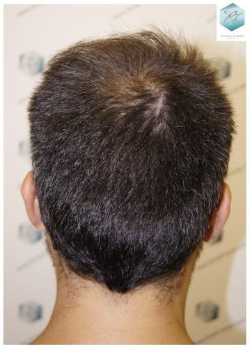 Injerto Capilar Técnica FUE 6230 Grafts (14226 Pelos) 50 trasplante de pelo valencia