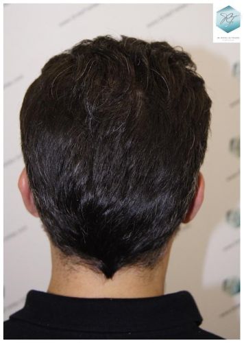 Injerto Capilar Técnica FUE 6230 Grafts (14226 Pelos) 49 trasplante de pelo valencia