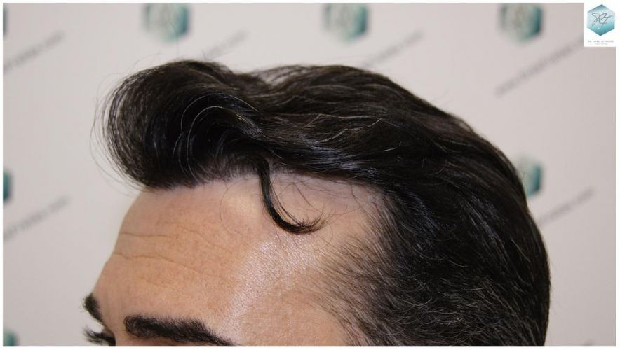Injerto Capilar Técnica FUE 6230 Grafts (14226 Pelos) 48 trasplante de pelo valencia