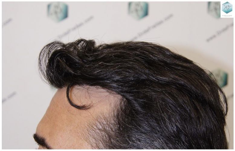 Injerto Capilar Técnica FUE 6230 Grafts (14226 Pelos) 47 trasplante de pelo valencia