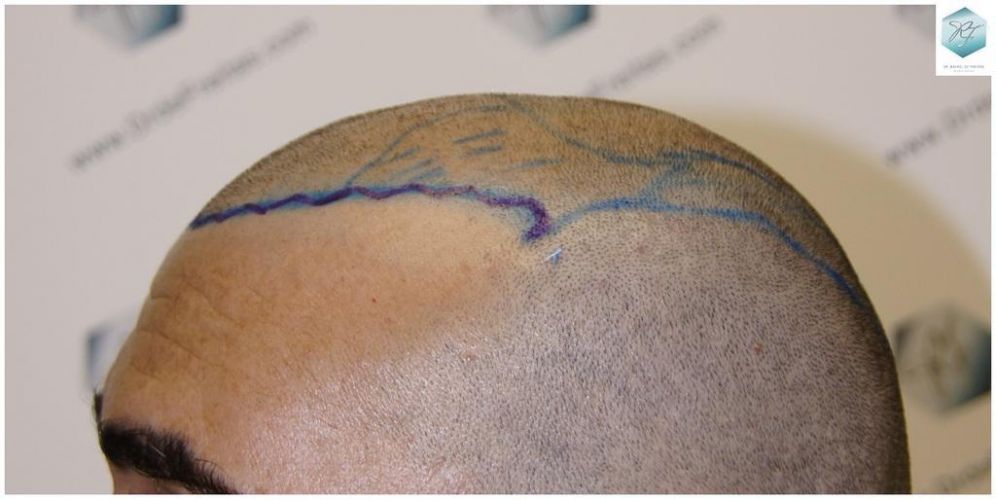 Injerto Capilar Técnica FUE 6230 Grafts (14226 Pelos) 9 trasplante de pelo valencia