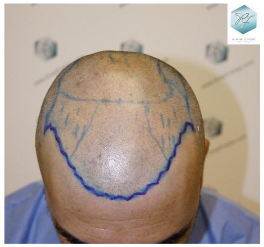 Injerto Capilar Técnica FUE 6230 Grafts (14226 Pelos) 7 trasplante de pelo valencia