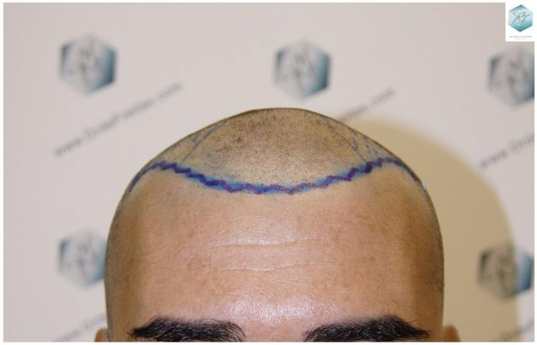 Injerto Capilar Técnica FUE 6230 Grafts (14226 Pelos) 6 trasplante de pelo valencia