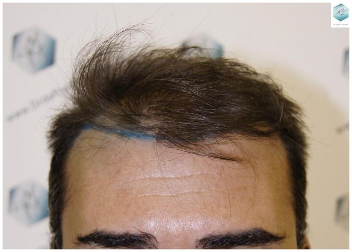 DISEÑO LINEA INJERTO trasplante de pelo valencia