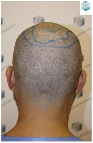 Injerto Capilar Técnica FUE 6230 Grafts (14226 Pelos) 11 trasplante de pelo valencia