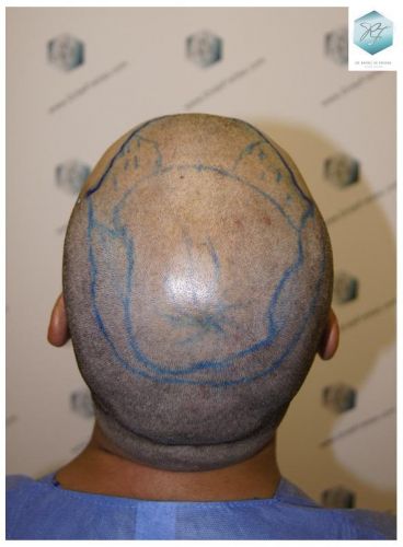 Injerto Capilar Técnica FUE 6230 Grafts (14226 Pelos) 10 trasplante de pelo valencia