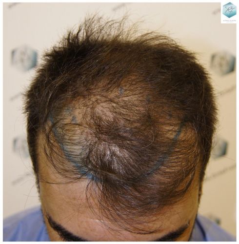 Injerto Capilar Técnica FUE 6230 Grafts (14226 Pelos) 4 trasplante de pelo valencia