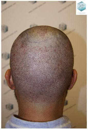 Injerto Capilar Técnica FUE 6230 Grafts (14226 Pelos) 24 trasplante de pelo valencia