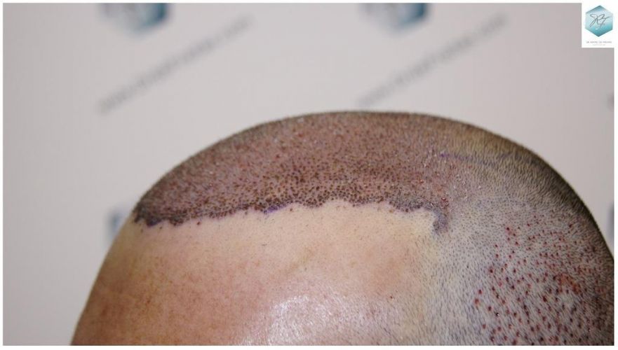Injerto Capilar Técnica FUE 6230 Grafts (14226 Pelos) 21 trasplante de pelo valencia