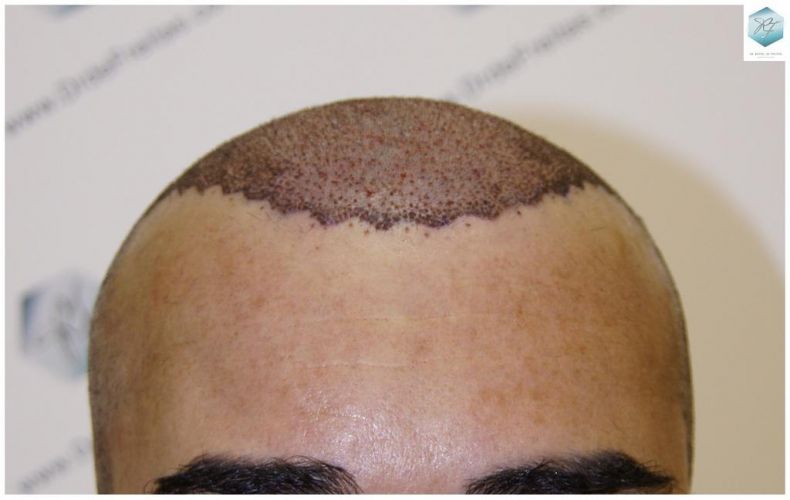 TRASPLANTE CAPILAR trasplante de pelo valencia