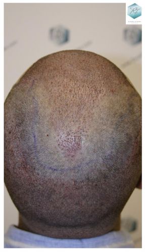 Injerto Capilar Técnica FUE 6230 Grafts (14226 Pelos) 52 trasplante de pelo valencia