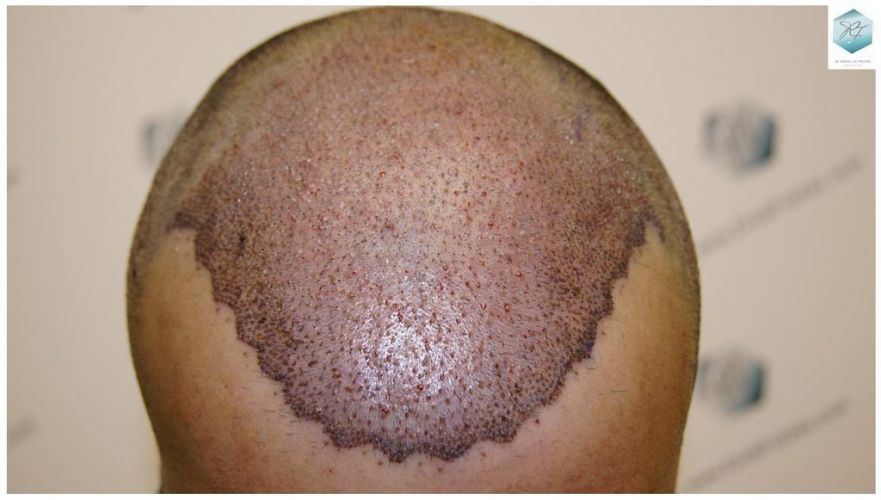 Injerto Capilar Técnica FUE 6230 Grafts (14226 Pelos) 15 trasplante de pelo valencia