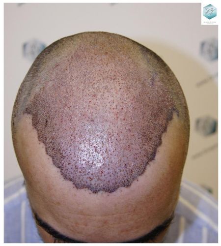 Injerto Capilar Técnica FUE 6230 Grafts (14226 Pelos) 16 trasplante de pelo valencia