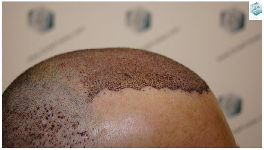 Injerto Capilar Técnica FUE 6230 Grafts (14226 Pelos) 19 trasplante de pelo valencia