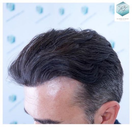 Injerto Capilar Técnica FUE 6230 Grafts (14226 Pelos) 36 trasplante de pelo valencia