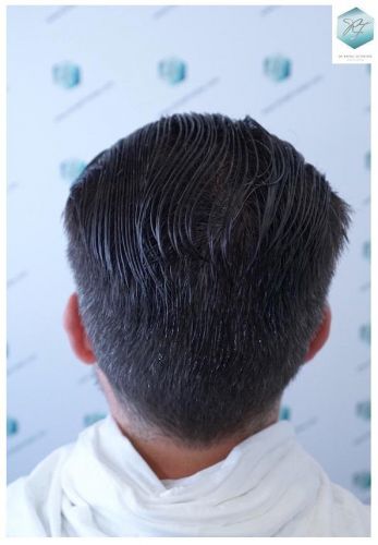 Injerto Capilar Técnica FUE 6230 Grafts (14226 Pelos) 43 trasplante de cabello