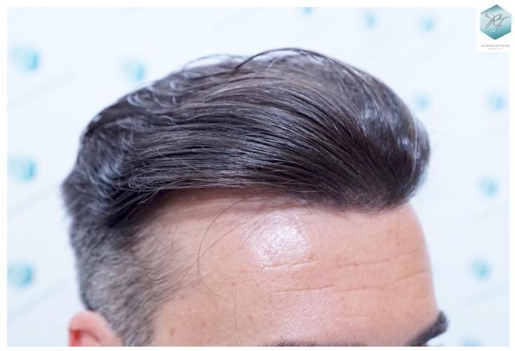 Injerto Capilar Técnica FUE 6230 Grafts (14226 Pelos) 34 trasplante de cabello