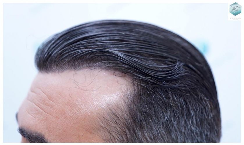Injerto Capilar Técnica FUE 6230 Grafts (14226 Pelos) 35 trasplante de cabello