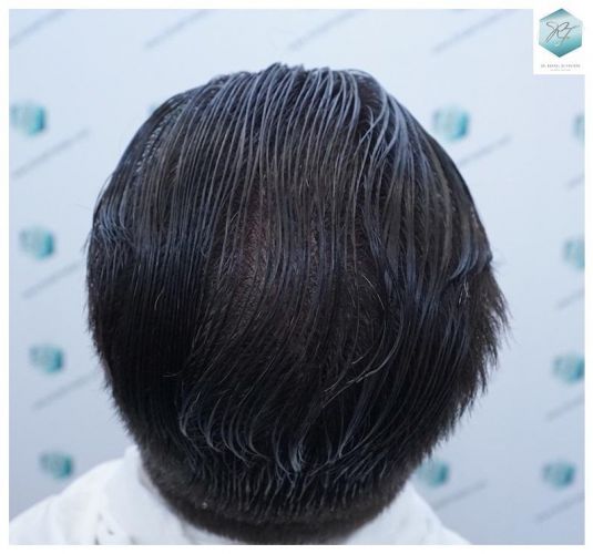 Injerto Capilar Técnica FUE 6230 Grafts (14226 Pelos) 41 trasplante de cabello