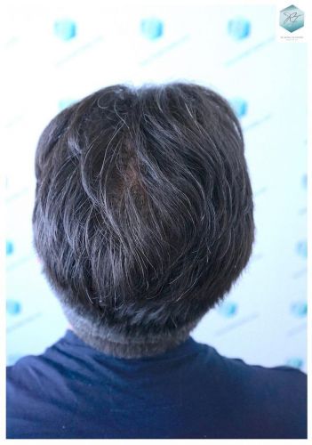 Injerto Capilar Técnica FUE 6230 Grafts (14226 Pelos) 40 trasplante de cabello