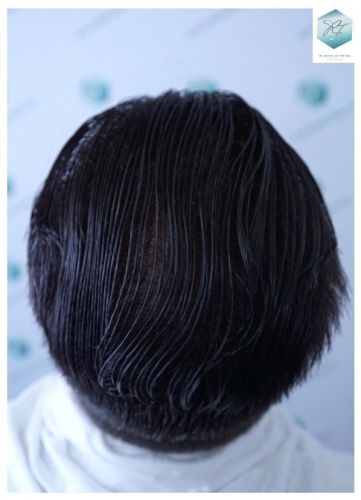 Injerto Capilar Técnica FUE 6230 Grafts (14226 Pelos) 42 trasplante de cabello