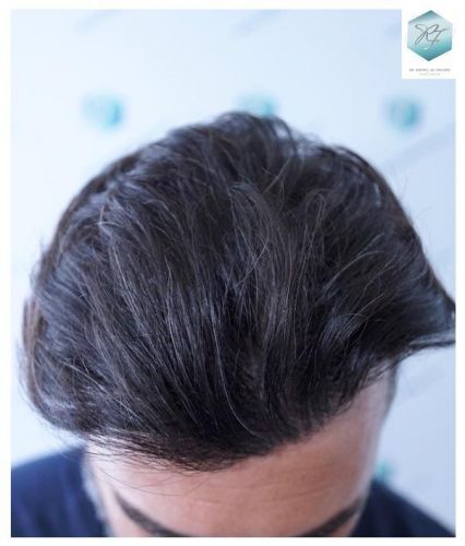 Injerto Capilar Técnica FUE 6230 Grafts (14226 Pelos) 27 trasplante de cabello