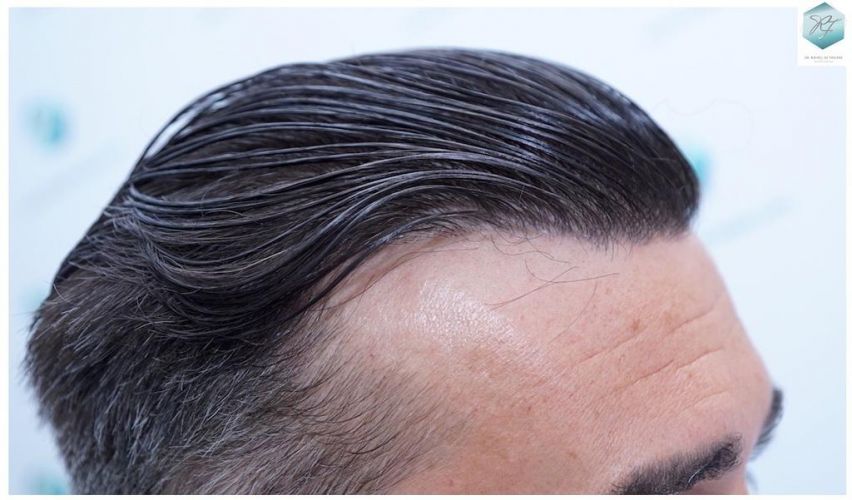 Injerto Capilar Técnica FUE 6230 Grafts (14226 Pelos) 33 trasplante de cabello