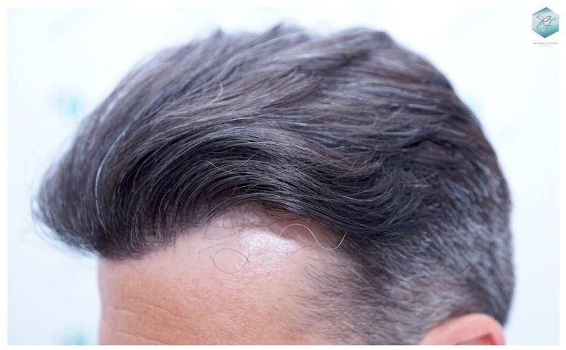 Injerto Capilar Técnica FUE 6230 Grafts (14226 Pelos) 37 trasplante de cabello