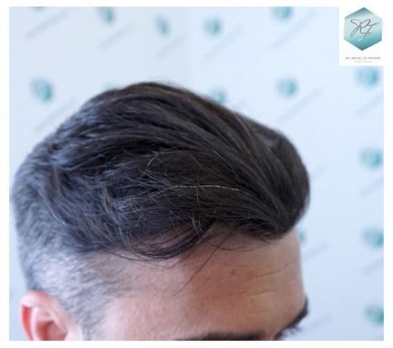 Injerto Capilar Técnica FUE 6230 Grafts (14226 Pelos) 29 trasplante de cabello
