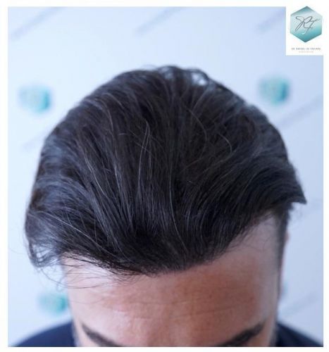 Injerto Capilar Técnica FUE 6230 Grafts (14226 Pelos) 28 trasplante de cabello