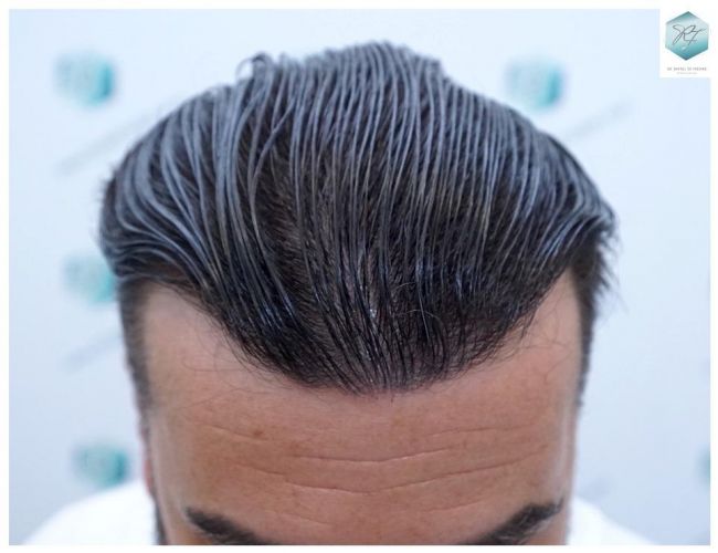 Injerto Capilar Técnica FUE 6230 Grafts (14226 Pelos) 39 trasplante de cabello
