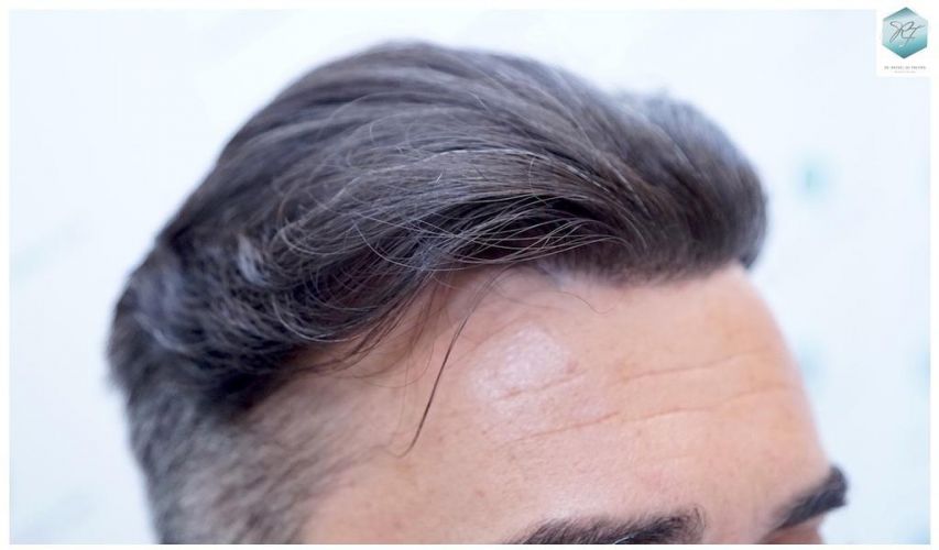 Injerto Capilar Técnica FUE 6230 Grafts (14226 Pelos) 31 trasplante de cabello