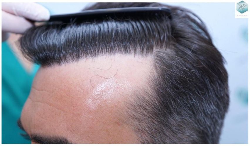 Injerto Capilar Técnica FUE 6230 Grafts (14226 Pelos) 38 trasplante de cabello