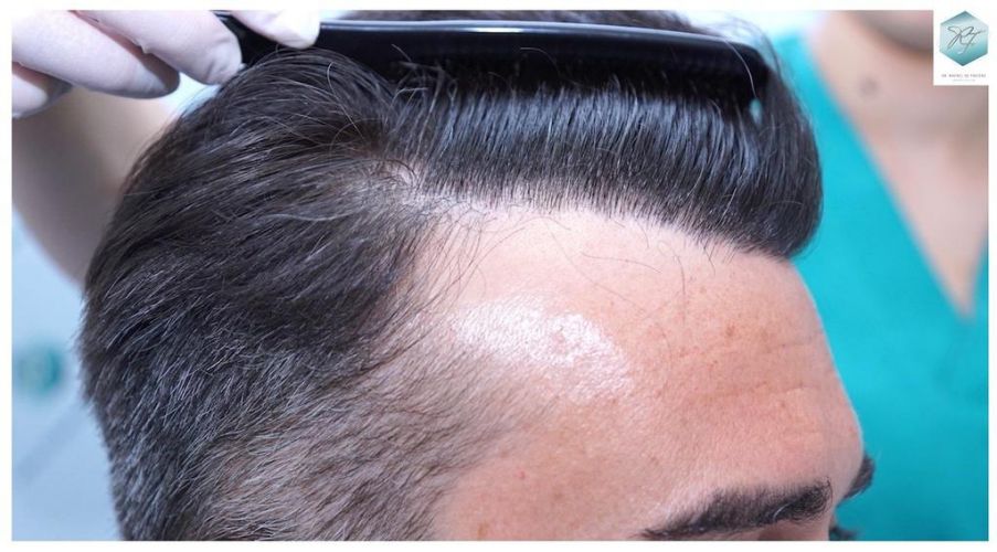 Injerto Capilar Técnica FUE 6230 Grafts (14226 Pelos) 30 trasplante de cabello