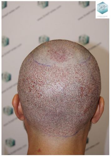 Injerto Capilar Técnica FUE 6230 Grafts (14226 Pelos) 22 trasplante de pelo valencia