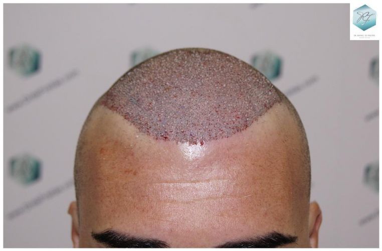 Injerto Capilar Técnica FUE 6230 Grafts (14226 Pelos) 12 trasplante de pelo valencia