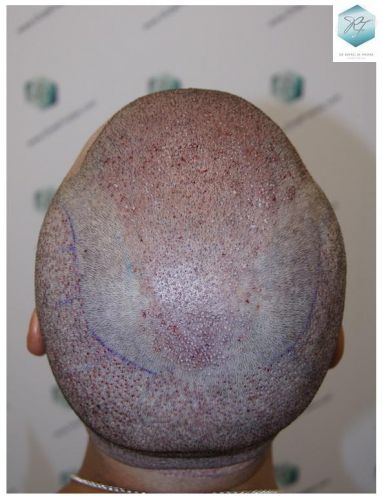 Injerto Capilar Técnica FUE 6230 Grafts (14226 Pelos) 23 trasplante de pelo valencia