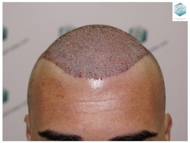 Injerto Capilar Técnica FUE 6230 Grafts (14226 Pelos) 17 trasplante de pelo valencia