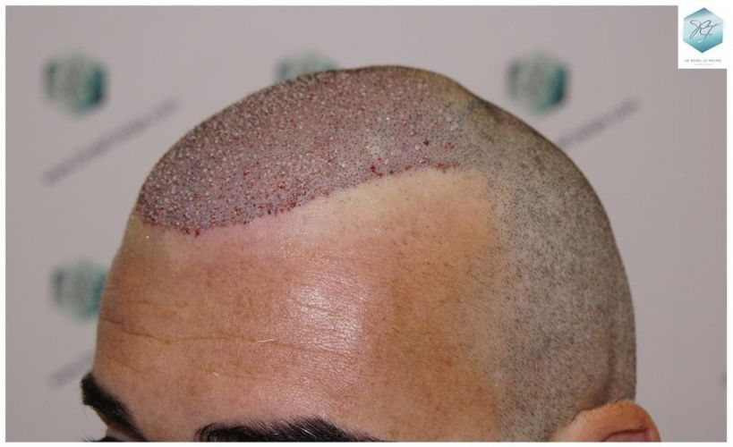 Injerto Capilar Técnica FUE 6230 Grafts (14226 Pelos) 20 trasplante de pelo valencia
