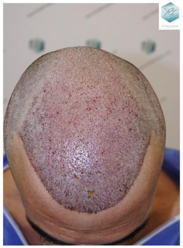 Injerto Capilar Técnica FUE 6230 Grafts (14226 Pelos) 14 trasplante de pelo valencia